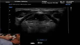 Tutorial de ultrassonografia Cervical - Vol. 05