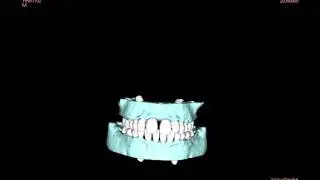 3D Image Movie Of Hard & Soft Tissue On An Orthodontic Patient