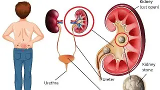 How To Formation Of The Kidney Stone and It's Laser Treatment #kidneystone