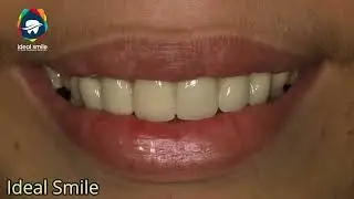 Get Your Previous Unaesthetic Dental Work Fixed With Warranty