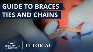 How to Use Elastic Ties, Power Chains, and Steel Ties | Orthodontics of Weston - Dr. Marissa Cooper