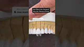 How much do veneers cost and how are they priced?