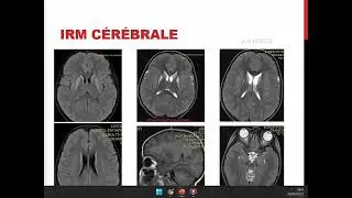 Stratégie diagnostique devant des anomalies de signal des noyaux gris centraux chez l'enfant