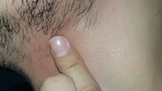 Blackheads removal | skincare Transformation | asmr satisfying routine | Ingrown hair Treatment