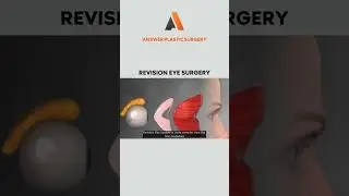 Revision Eye Surgery | Answer Plastic Surgery #shorts #revisioneyesurgery