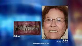 No More Dentures! with San Diego dentist Christopher Henninger, DMD