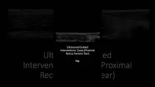 #Ultrasound Guided Interventions: Cases (Proximal Rectus Femoris Tear)