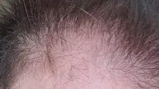 Microneedling for hair loss. Why i wouldnt do it again