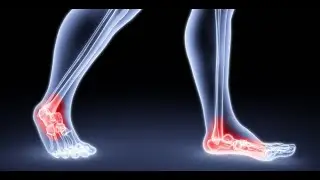 Post‑traumatic arthropathy; degenerative joint disease that develops after an injury to a joint