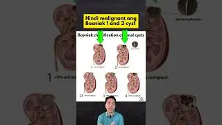 Ano ang mga Klase ng Cysts sa Kidneys?