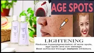 Dark spots/ Hyper Pigmentation | DXN Chubby baby oil/ Ganoderma explained by Dr. Prerna