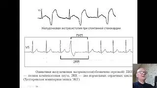 Ходунов О.Б. Видеолекция. Экстрасистолия. Часть 5. 2026