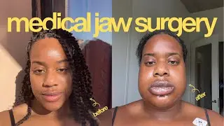 jaw surgery ruined my life..