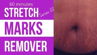 The Secret to Removing Stretch Marks in Just 60 Seconds! | Cellulite | Scars| Eczema