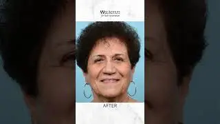 Before and after results of an FUT hair transplant! This strip method is great for women! #fut