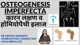 क्या है OSTEOGENESIS IMPERFECTA व होम्योपैथिक इलाज | Brittle Bone Disease के लिए होमियोपैथी