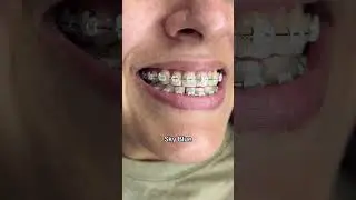 Braces colours trending#bracesupdate #dentist #dentalbraces #care #orthodontist #shorts#trending