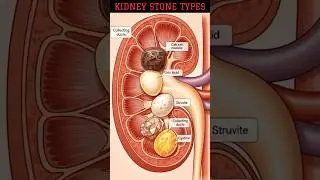 Different Types of Kidney Stones #kidneystone