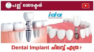 Dental Implant ചിലവ് എത്ര? l 