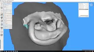 Creating a Mold for an Implant Retaine Prosthetic Ear Using Meshmixer