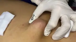 &ldquo;Satisfying Sebaceous Cyst Removal | Pimple Popping Video&rdquo;