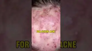 Finding the right cleanser for acne skin