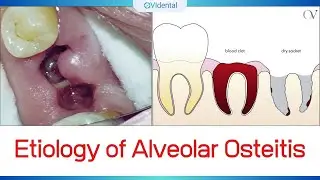 🚫 Etiology of Alveolar Osteitis (AO)