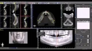 Blue Sky Plan Training Tutorial: Loading Patient Photo in 3D View