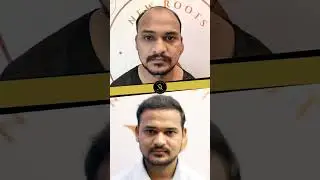 5000 Grafts | Before & After | Grade 7 Baldness Results | Hair Restoration |