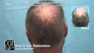 Rethinking Unfixable Hair Transplant Repairs With Dr.UGraft - How This Man Beat the Odds