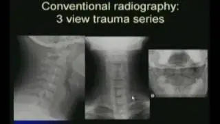 Cervical Spine AP View