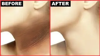 Remove Dark Neck FAST (3 Easy Home Remedies)