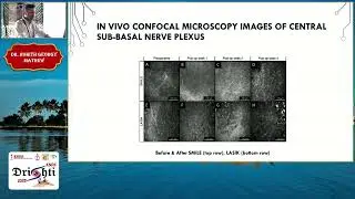 KSOS 2025   IC47   T Dr Rohith Georgy Mathew Clinical outcomes in SMILE surgery