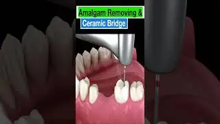 Mercury-Free, Stress-Free: Go Ceramic Today!