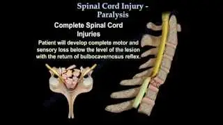 Spinal Cord Injury / Paralysis - Everything You Need To Know - Dr. Nabil Ebraheim