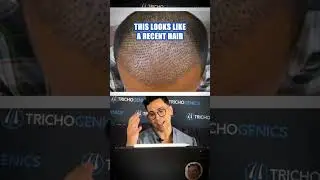 Hair transplant Fails #hairloss #hair #hairtransplant #hairtransplantbeforeafter
