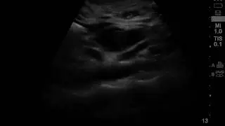 Ultrasound guided caeliac plexus alcohol neurolysis.