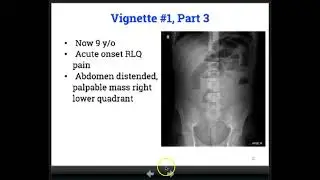 Cystic Fibrosis Gastrointestinal Manifestations, Part 2