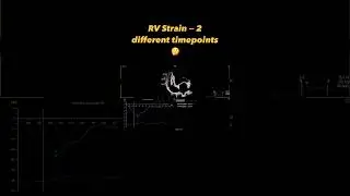 RV strain measurement in 2 different vendors #echocardiography  #ultrasound #cardiology