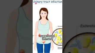 Quick Tips to Prevent UTIs @uti @healthcare