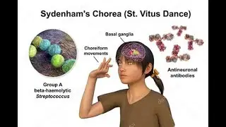Sydenham chorea St Vitus dance in Acute Rheumatic Fever