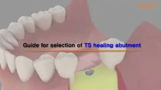 TSIII Rigid Abutment