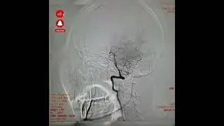 Tindakan DSA dengan hasil normal