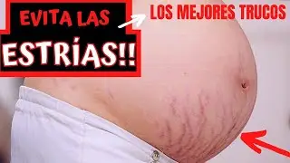 📢 Los mejores trucos para evitar estrías en el embarazo 🤰🏻