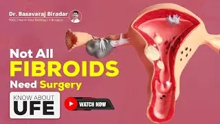 What Is Uterine Fibroid Embolization? Fibroid Treatment Without Surgery in #bangalore #womenshealth 