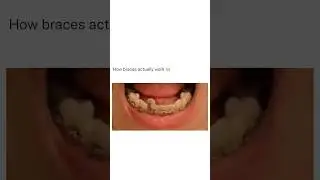 Dentist Reveals Secret That Could Save You 4 Teeth! 🦷😬