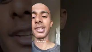 DAY 02 of harigrowth under 45 days 🔥 #shorts #trending #funny #hairgrowth #youtubeshorts