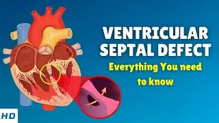Ventricular Septal Defect (VSD) &ndash; Causes, Signs and Symptoms, Diagnosis & Treatment