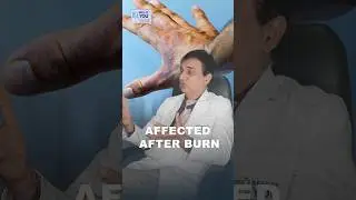 Industrial Burn Scars Treatment | How to Treat? Burn Scar Treatment in Delhi | Dr. PK Talwar