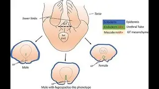 Absent or hypoplastic external genitalia; congenital underdevelopment or complete absence